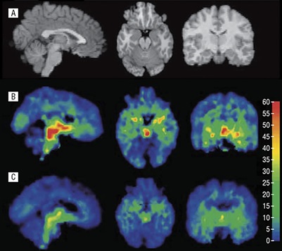 PET and MRI imaging of a brain